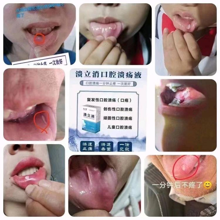 口腔溃疡